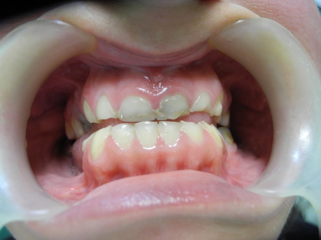 implantes dentarios antes